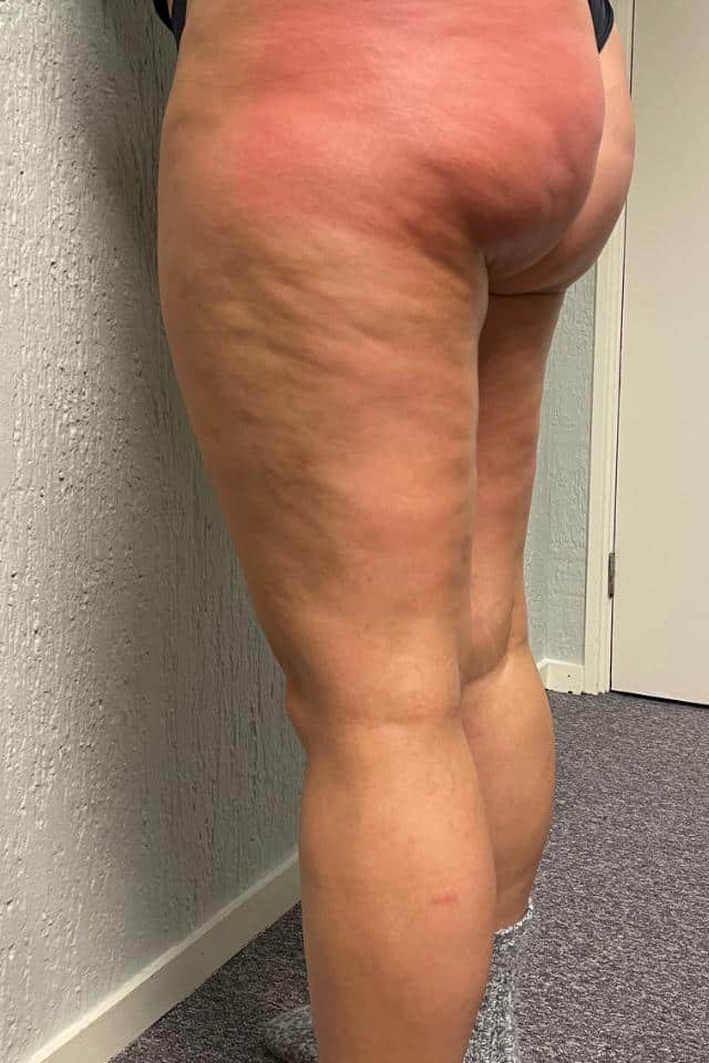 cellulite Cupping
